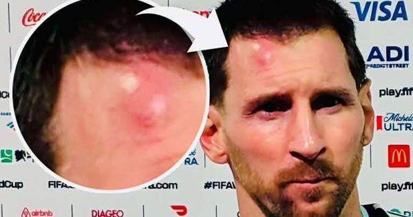 Messi sưng vêu trán sau trận thắng Cabo Verde: Vì sao nên nỗi? - hình ảnh - jun88go.vip